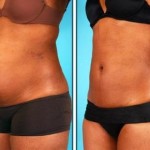 Abdominal Liposuction Cost Idea - Before and After Photos